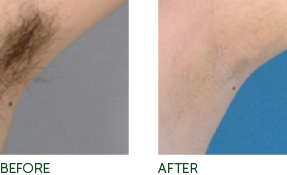 Diolux Before and After Image
